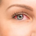 Can an Optometrist Treat Eye Problems?